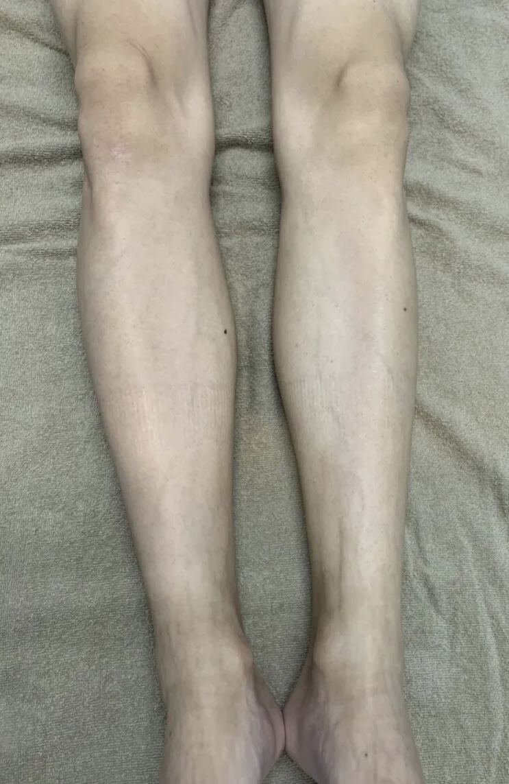 30代男性 足脱毛 施術後