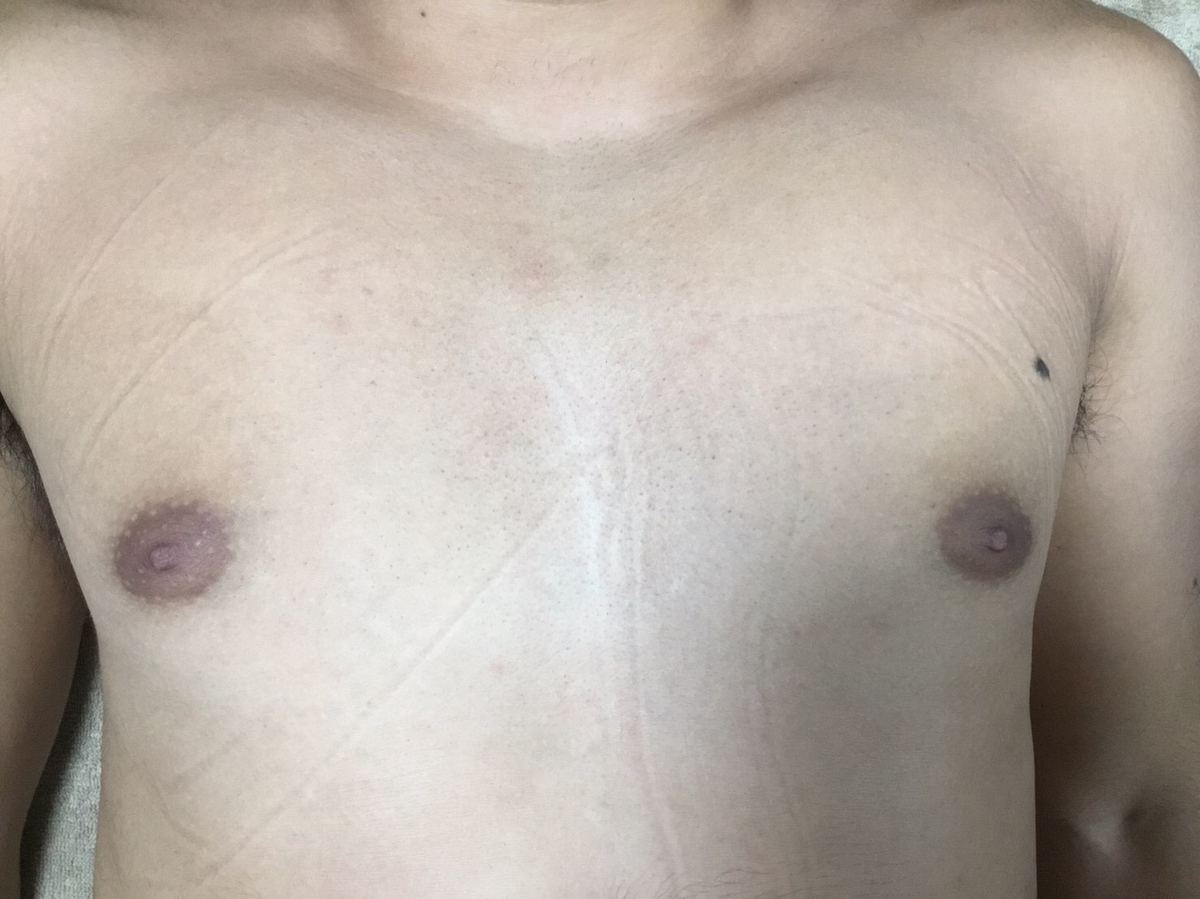 40代男性 胸脱毛 施術後