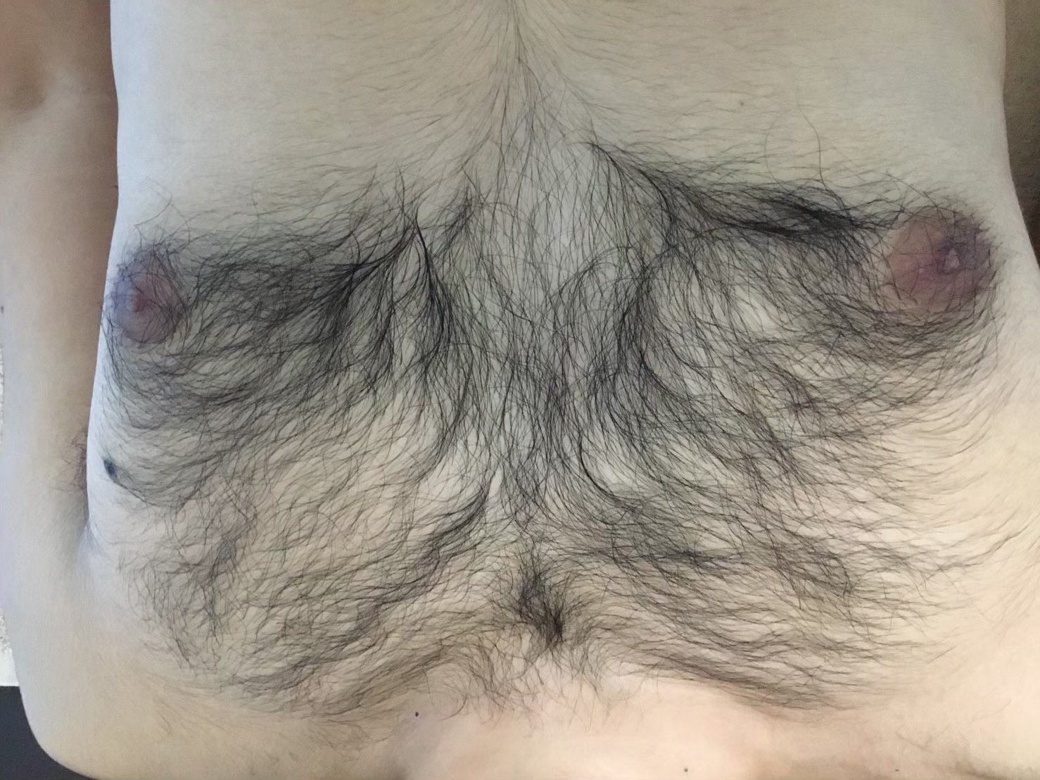 40代男性 胸脱毛 施術前