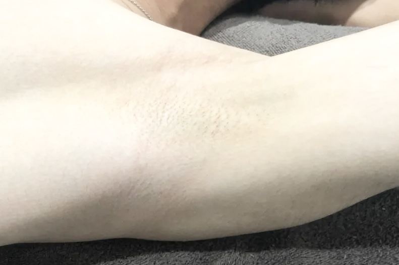 20代男性 脇脱毛 施術後