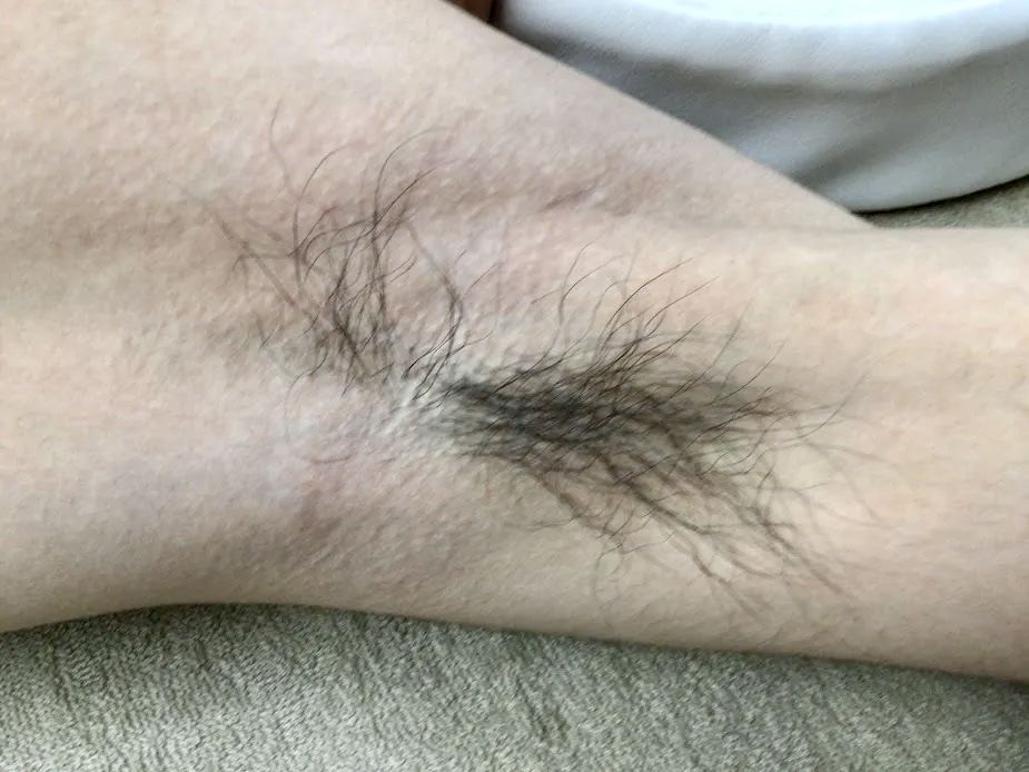 20代男性 脇脱毛 施術前